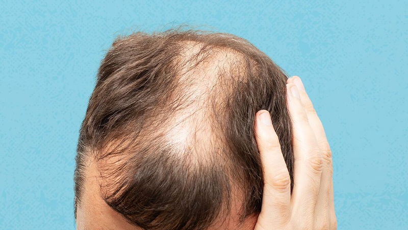 Mengatasi Kerontokan Rambut pada Pria Secara Alami – PAFI Bangko